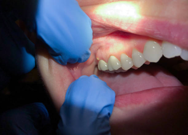 Best Emergency Treatment for Dental Infections or Abscesses in Pato, WA